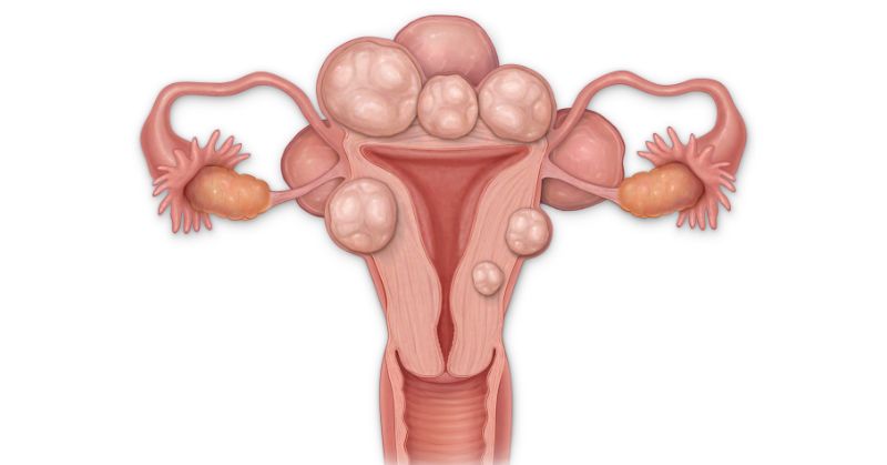 EGCG Uterine Fibroids