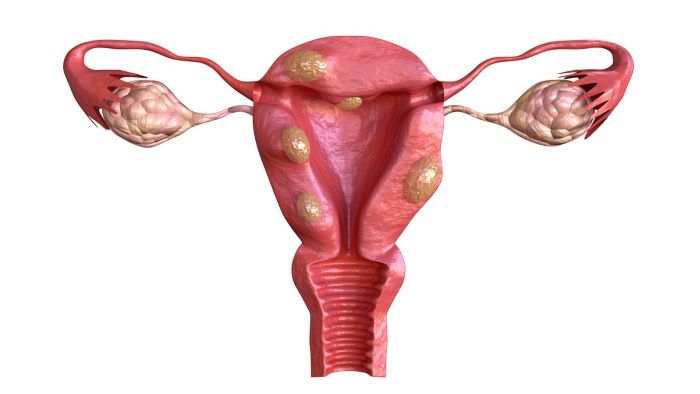 Uterine Fibroids